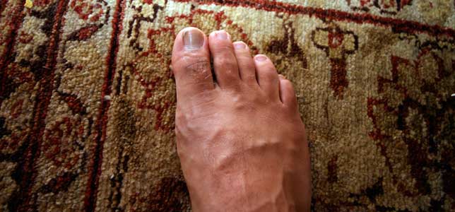 broken toe. Broken toe